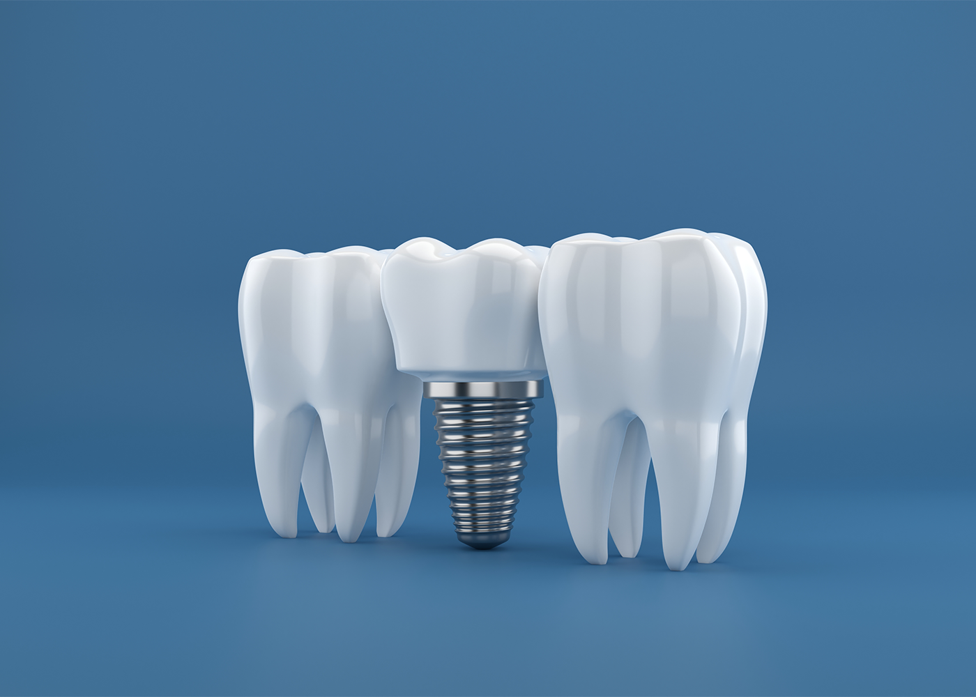 Detailed illustration of a dental implant procedure at Sukriti Hospital in Bharuch. High-quality dental implants for fixed teeth by Dr. Vihang Sukhadia.